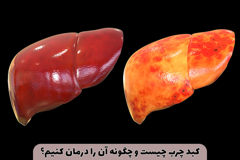 کبد چرب چیست و چگونه آن را درمان کنیم؟